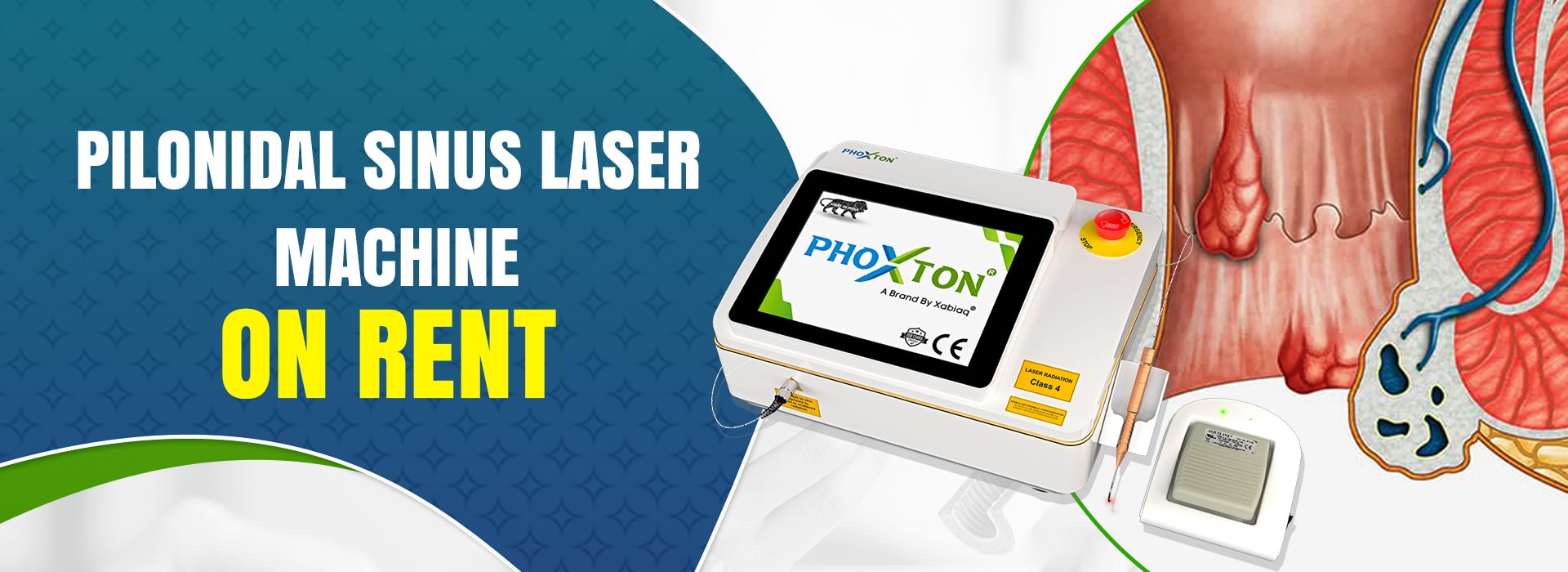 Pilonidal Sinus Laser Machine On Rent Pilonidal Sinus Laser Machine On Rent